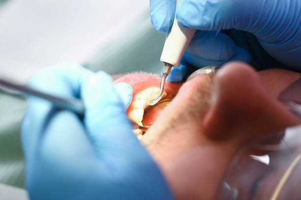 Best Emergency Tooth Extraction in Davis, OK